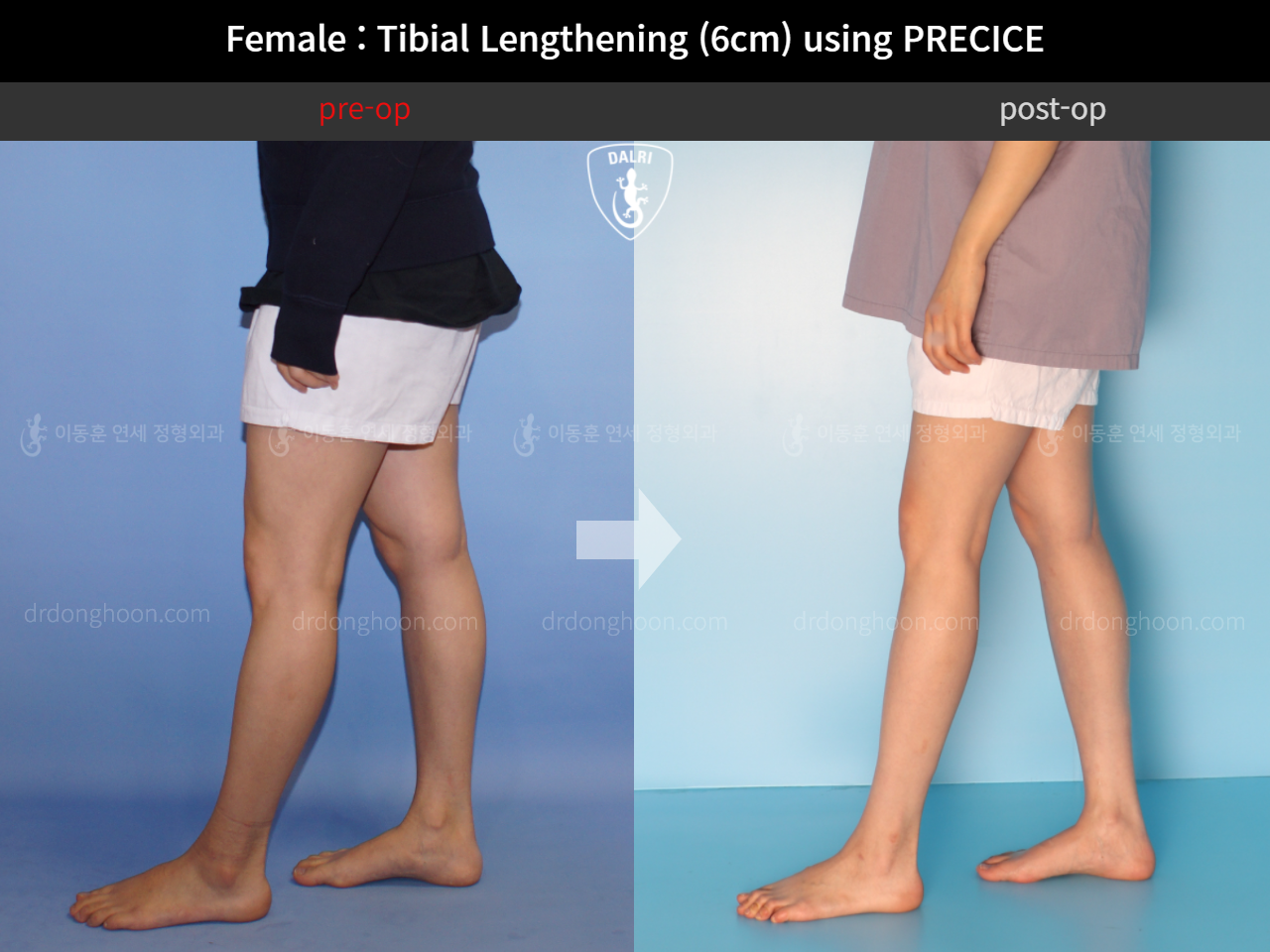 Before and after cll precice, case 11653827, image 7, Dr. Donghoon institute (DALRI)