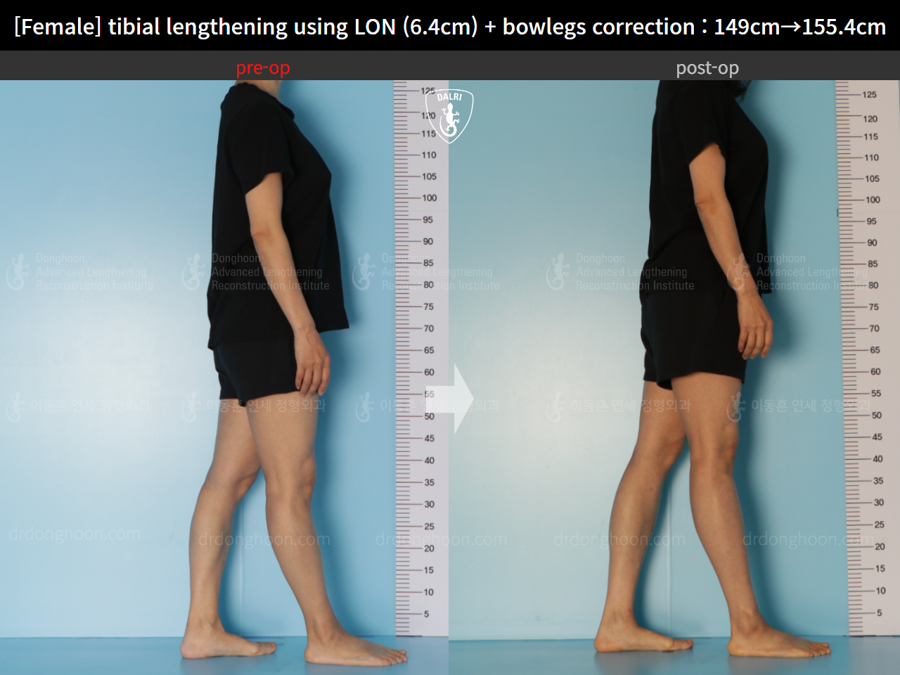 Before and after cll lon, case 15615051, image 3, Dr. Donghoon institute (DALRI)