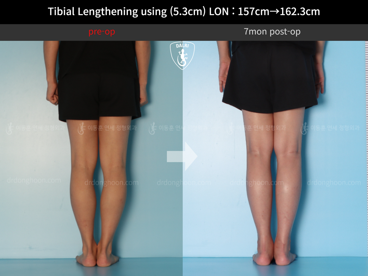 Before and after cll lon, case 12844512, image 7, Dr. Donghoon institute (DALRI)