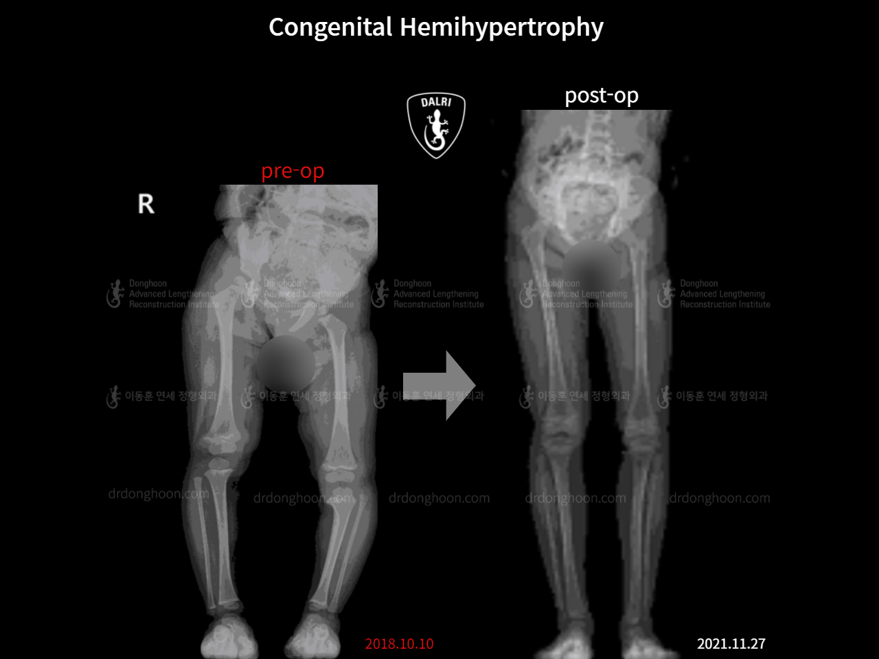 Before and after paediatric congenital condition, case 9478998, image 5, Dr. Donghoon institute (DALRI)