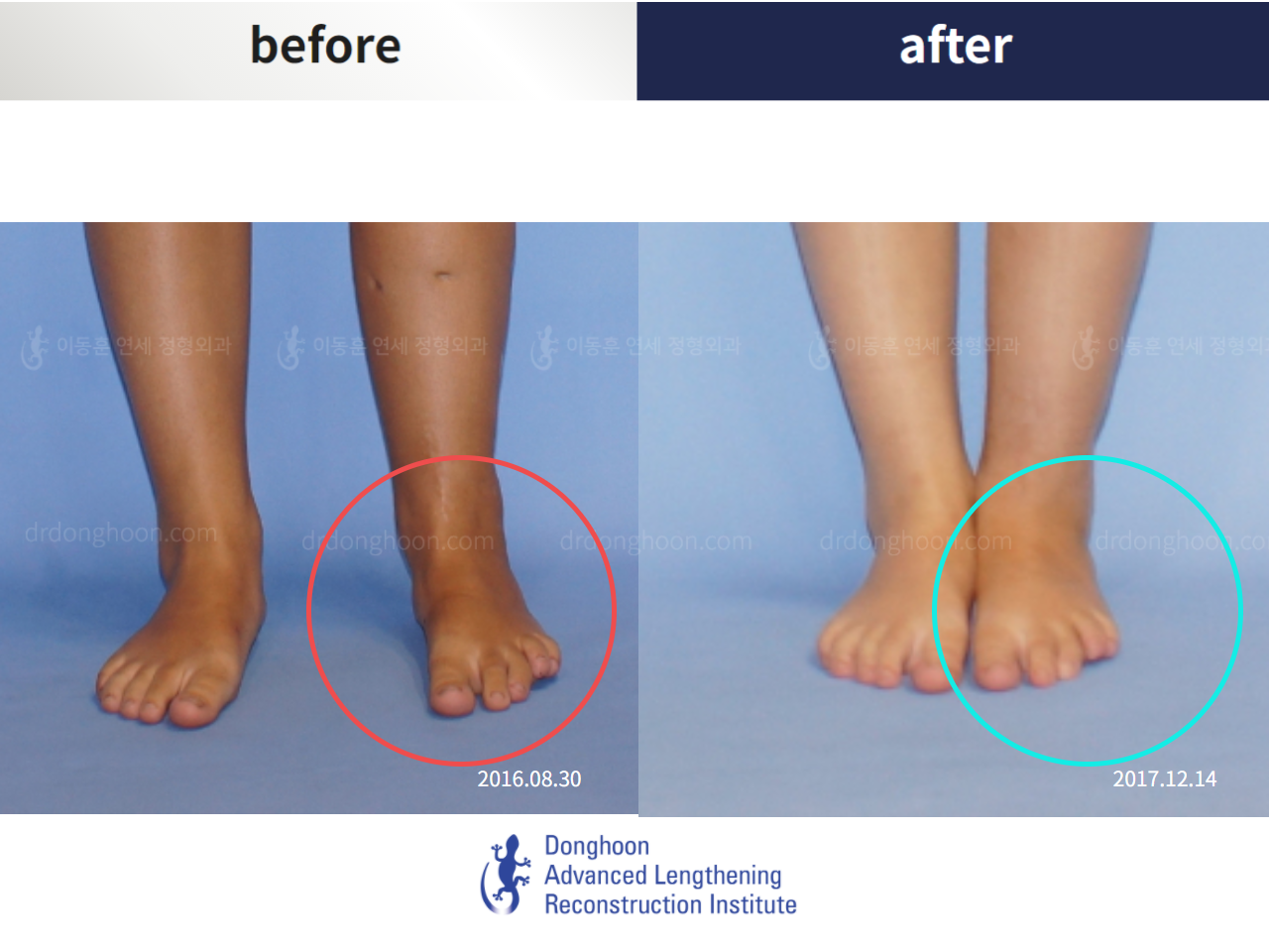 Before and after foot & ankle deformity, case 5313702, image 3, Dr. Donghoon institute (DALRI)