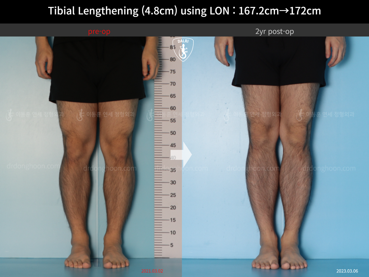 Before and after cll lon, case 14418932, image 5, Dr. Donghoon institute (DALRI)