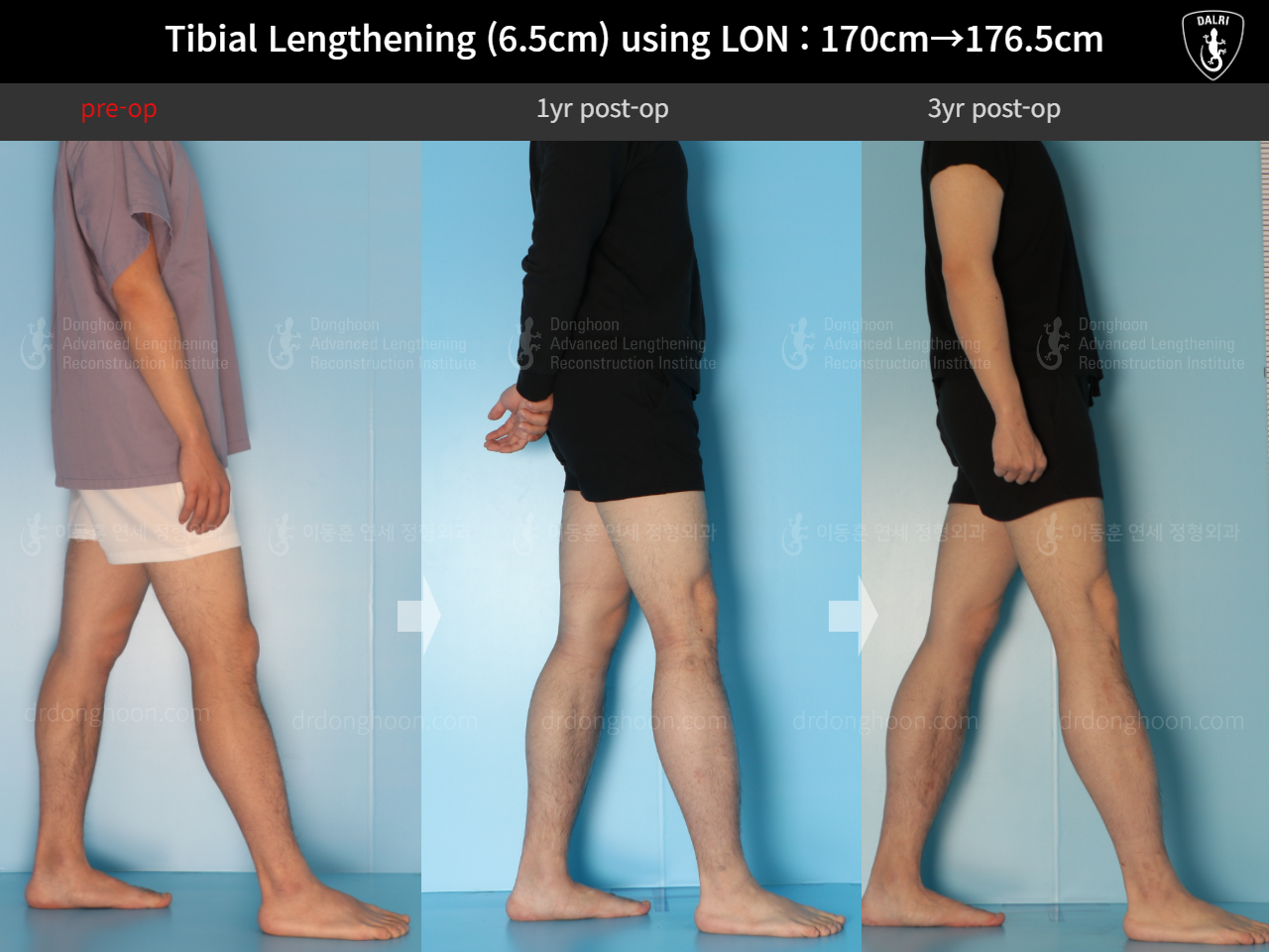 Before and after cll lon, case 16299082, image 4, Dr. Donghoon institute (DALRI)