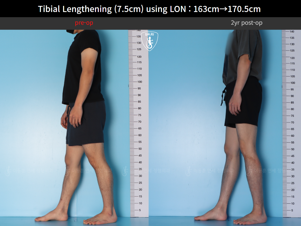 Before and after cll lon, case 125785462, image 6, Dr. Donghoon institute (DALRI)