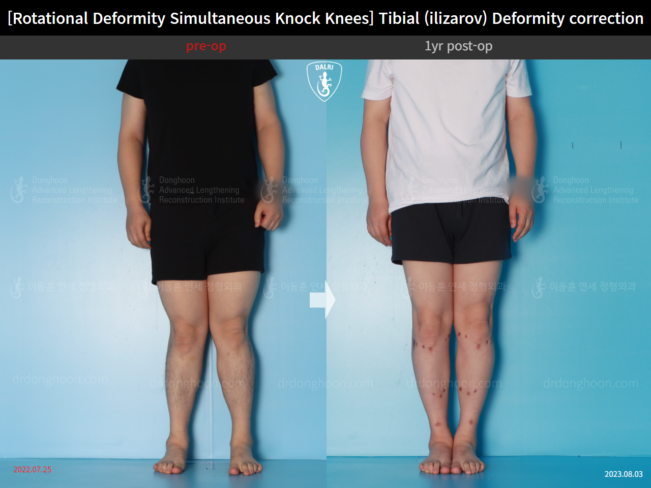 Before and after adult knock knees, case 15977455, image 1, Dr. Donghoon institute (DALRI)