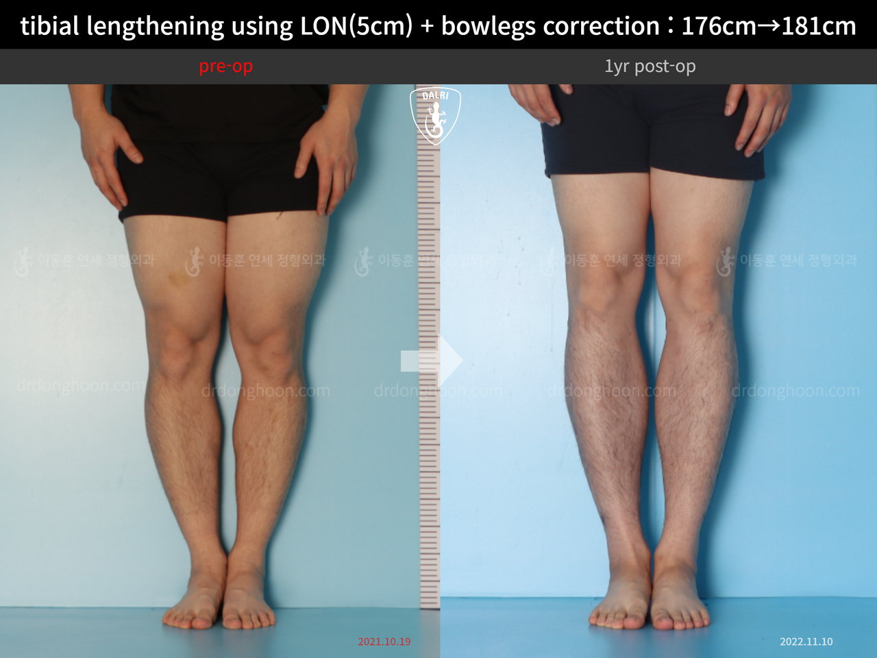 Before and after cll + deformity correction, case 13410849, image 7, Dr. Donghoon institute (DALRI)