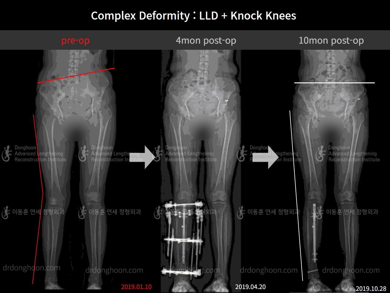 Before and after adult lld, case 9041582, image 4, Dr. Donghoon institute (DALRI)