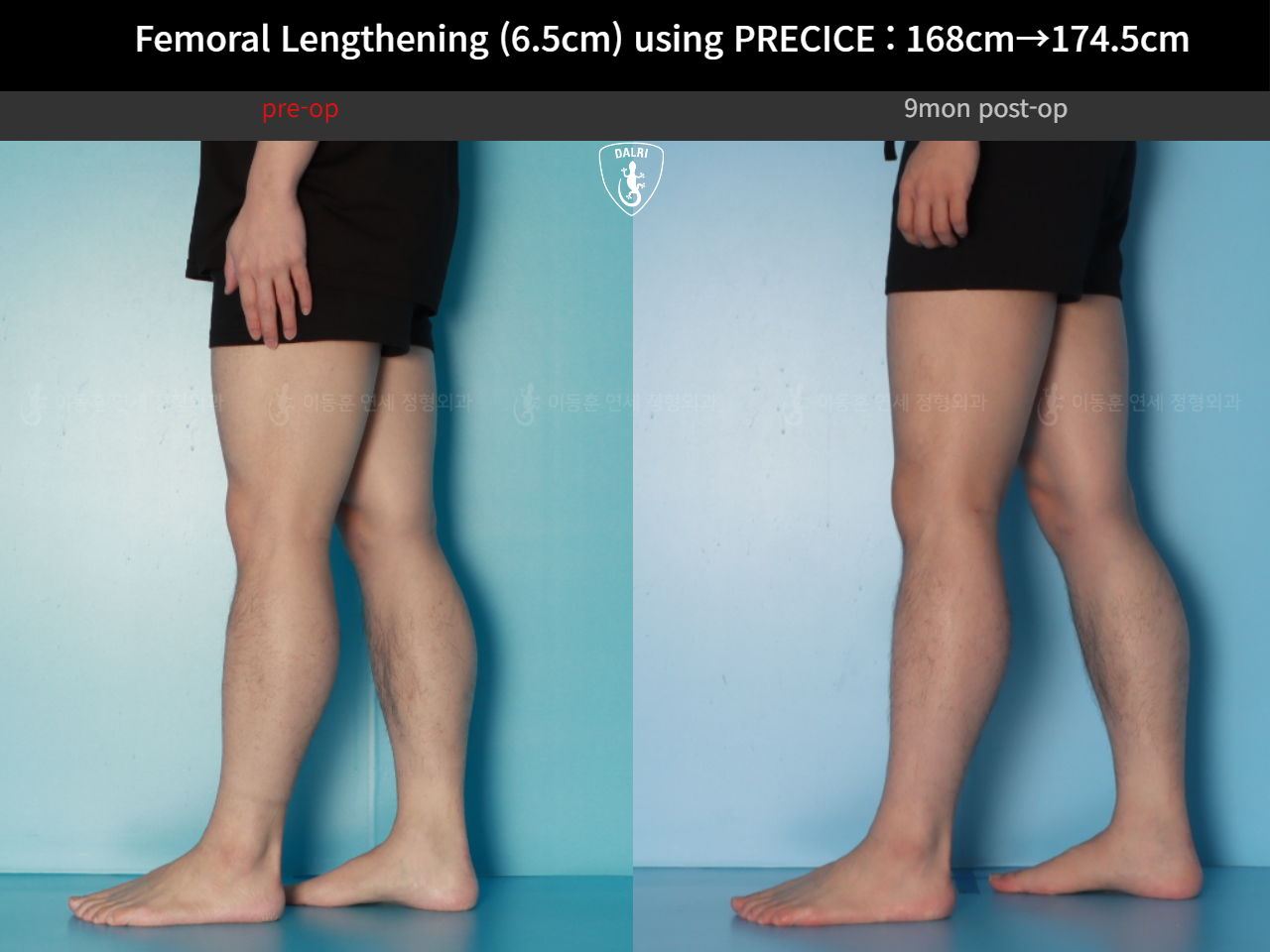 Before and after cll precice, case 123911358, image 9, Dr. Donghoon institute (DALRI)