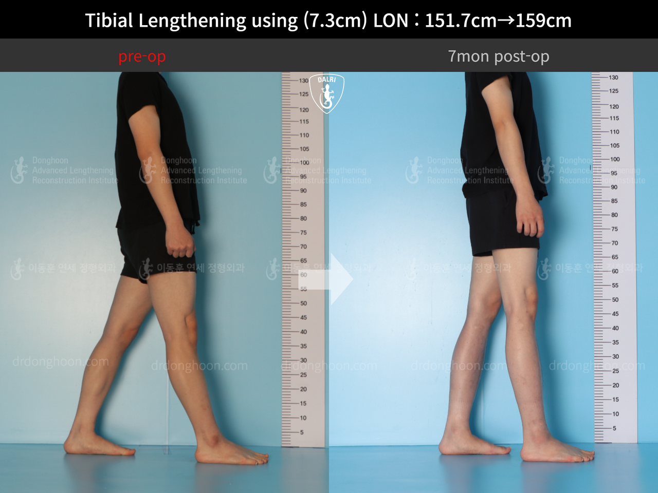 Before and after cll lon, case 13119336, image 3, Dr. Donghoon institute (DALRI)