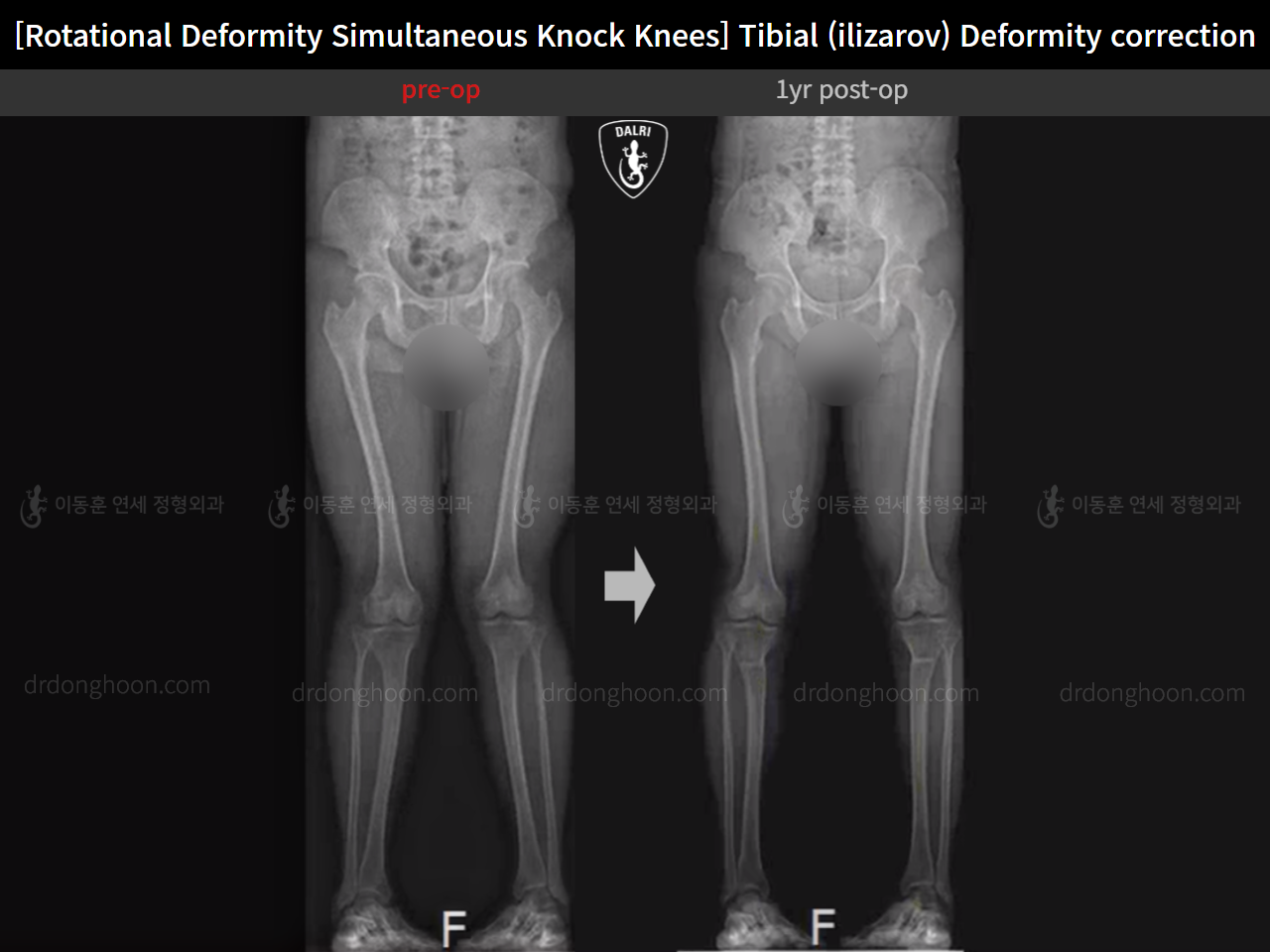 Before and after adult knock knees, case 15977455, image 10, Dr. Donghoon institute (DALRI)