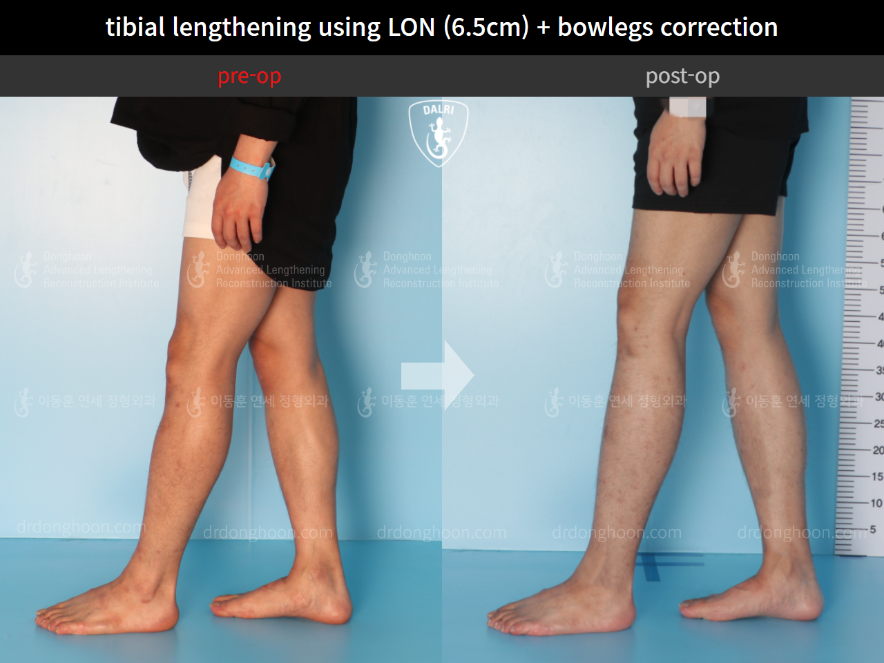 Before and after cll + deformity correction, case 4585639, image 7, Dr. Donghoon institute (DALRI)