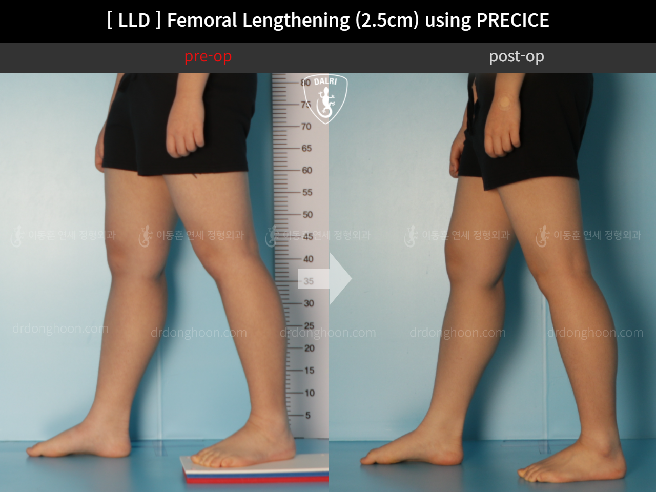 Before and after adult lld, case 11367647, image 7, Dr. Donghoon institute (DALRI)