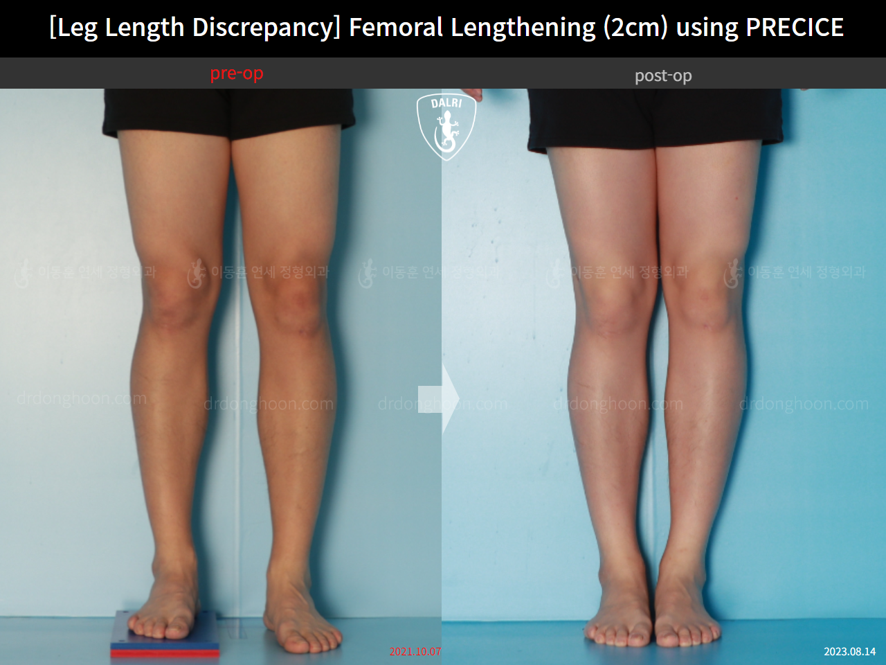 Before and after adult lld, case 16061128, image 6, Dr. Donghoon institute (DALRI)