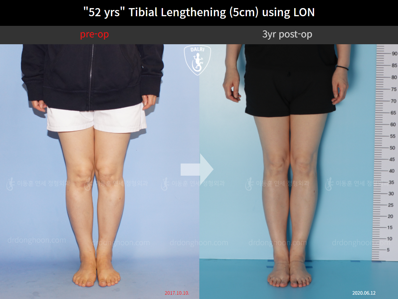 Before and after cll lon, case 9977769, image 5, Dr. Donghoon institute (DALRI)