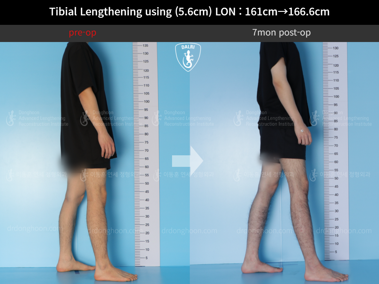 Before and after cll lon, case 5307318, image 4, Dr. Donghoon institute (DALRI)
