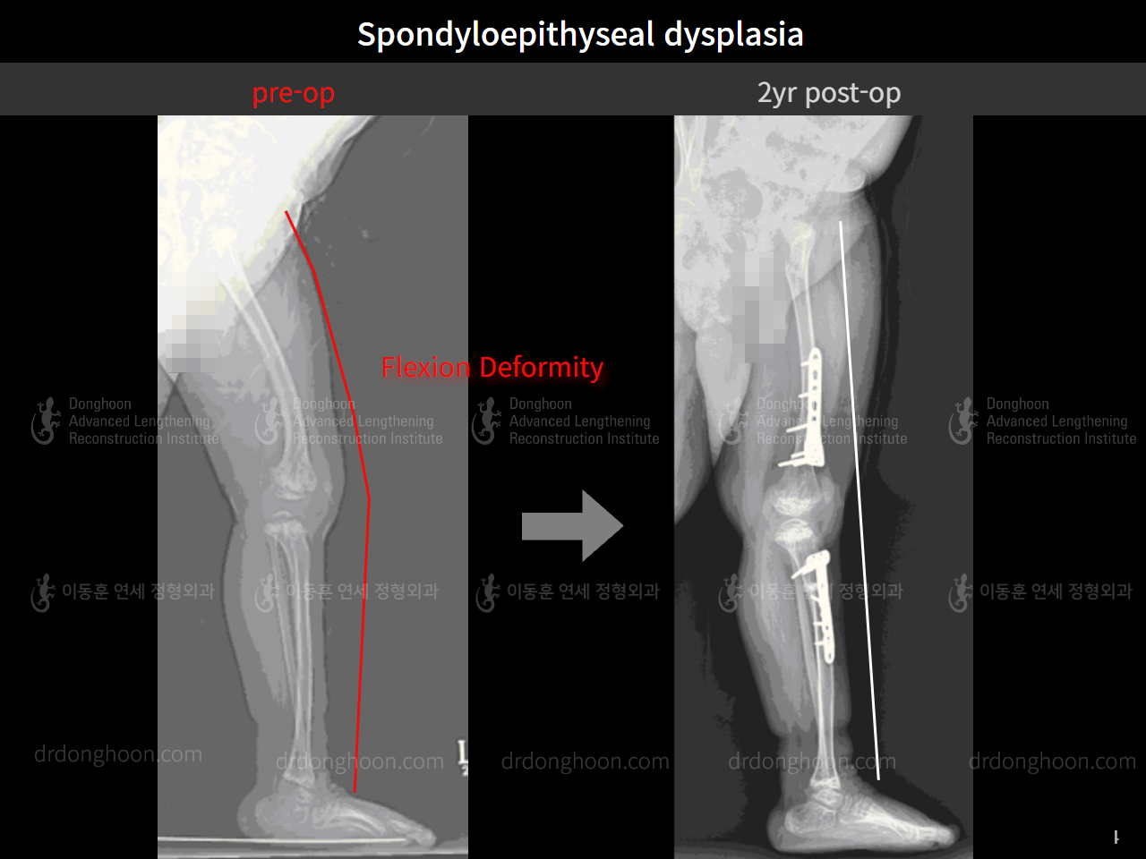 Before and after paediatric congenital condition, case 4304778, image 7, Dr. Donghoon institute (DALRI)