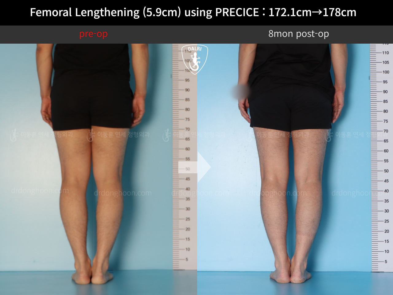 Before and after cll precice, case 13848850, image 9, Dr. Donghoon institute (DALRI)