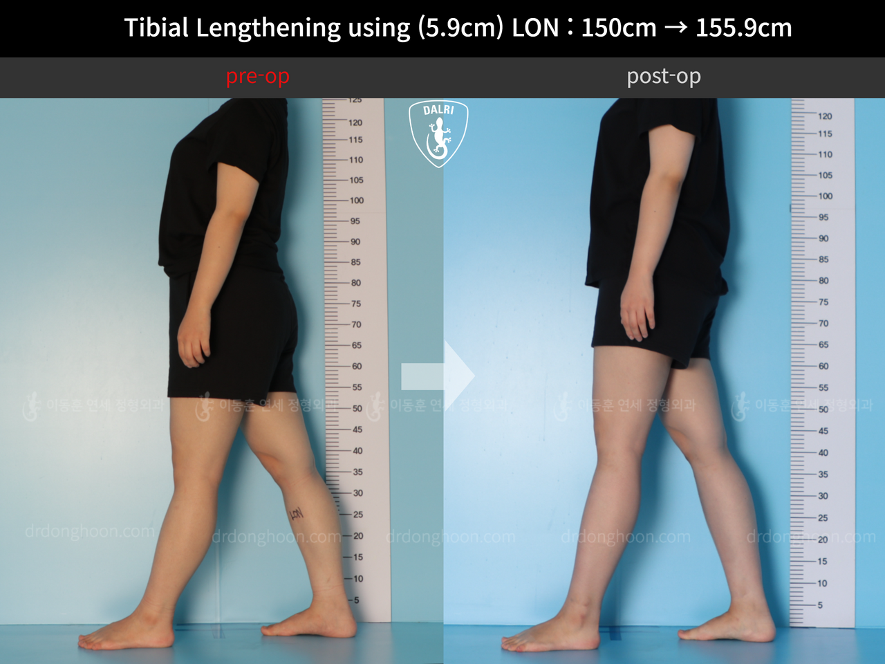 Before and after cll lon, case 12207071, image 4, Dr. Donghoon institute (DALRI)