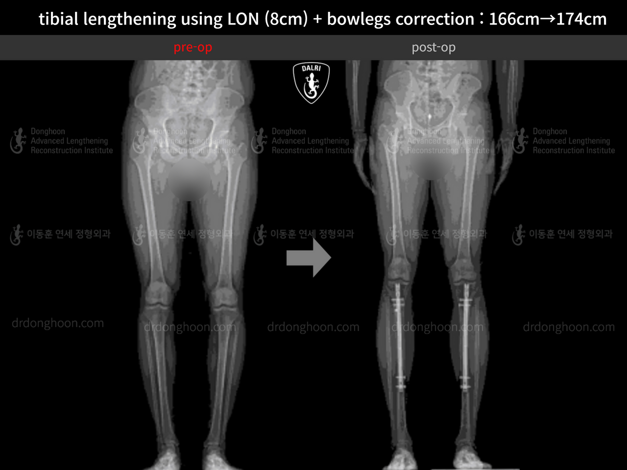 Before and after cll + deformity correction, case 13418165, image 2, Dr. Donghoon institute (DALRI)
