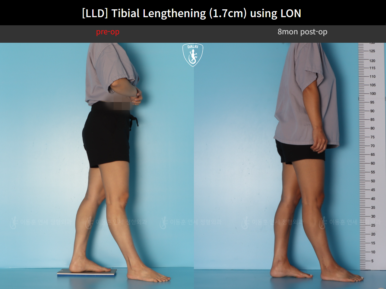 Before and after adult lld, case 126715948, image 3, Dr. Donghoon institute (DALRI)