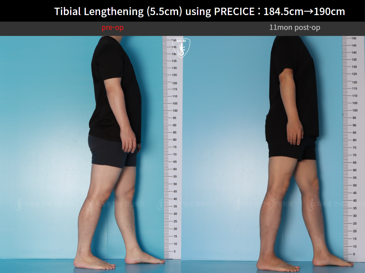 Before and after cll precice, case 125279355, image 6, Dr. Donghoon institute (DALRI)