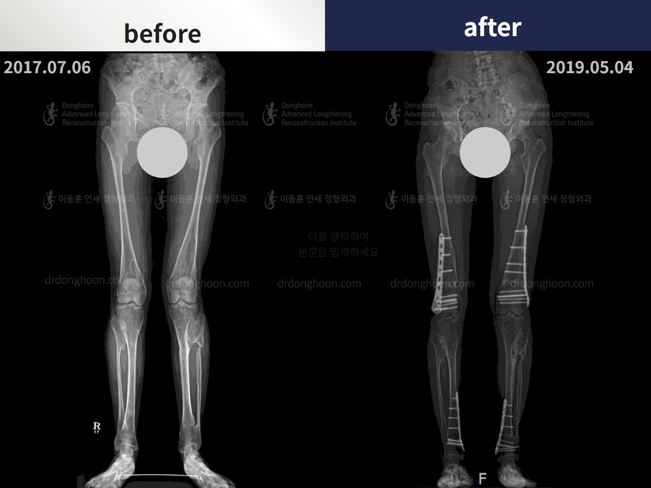 Before and after congenital condition, case 4304672, image 3, Dr. Donghoon institute (DALRI)