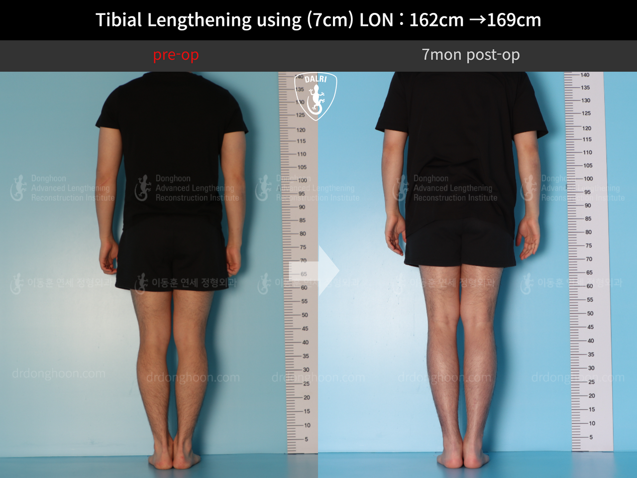 Before and after cll lon, case 13743472, image 3, Dr. Donghoon institute (DALRI)