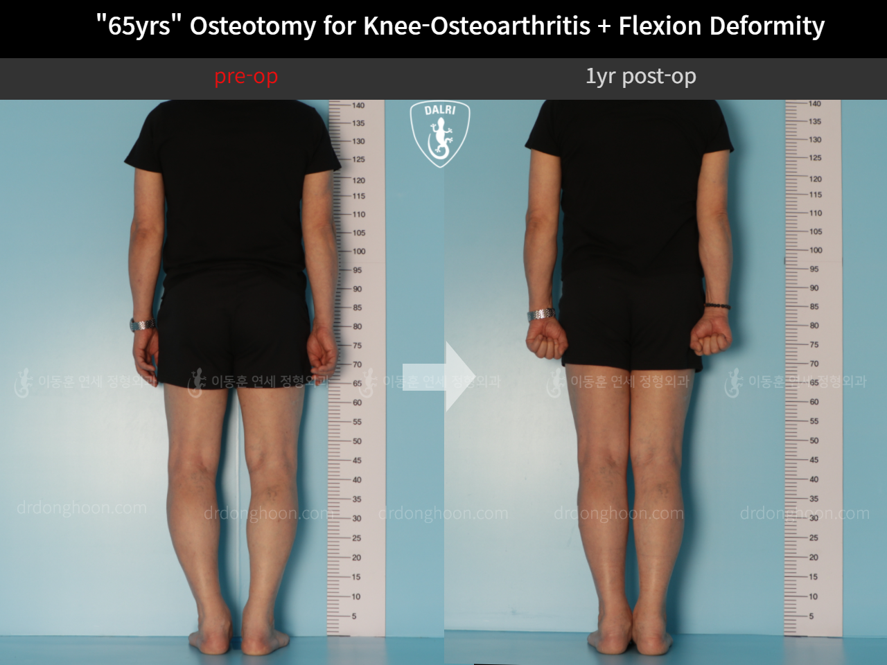 Before and after osteotomy for knee osteoarthritis, case 10742820, image 2, Dr. Donghoon institute (DALRI)