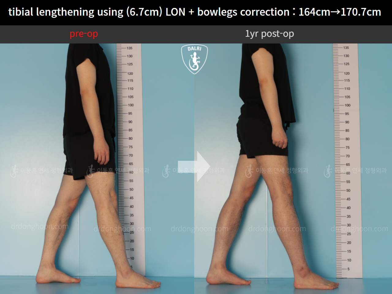 Before and after cll + deformity correction, case 11037343, image 3, Dr. Donghoon institute (DALRI)