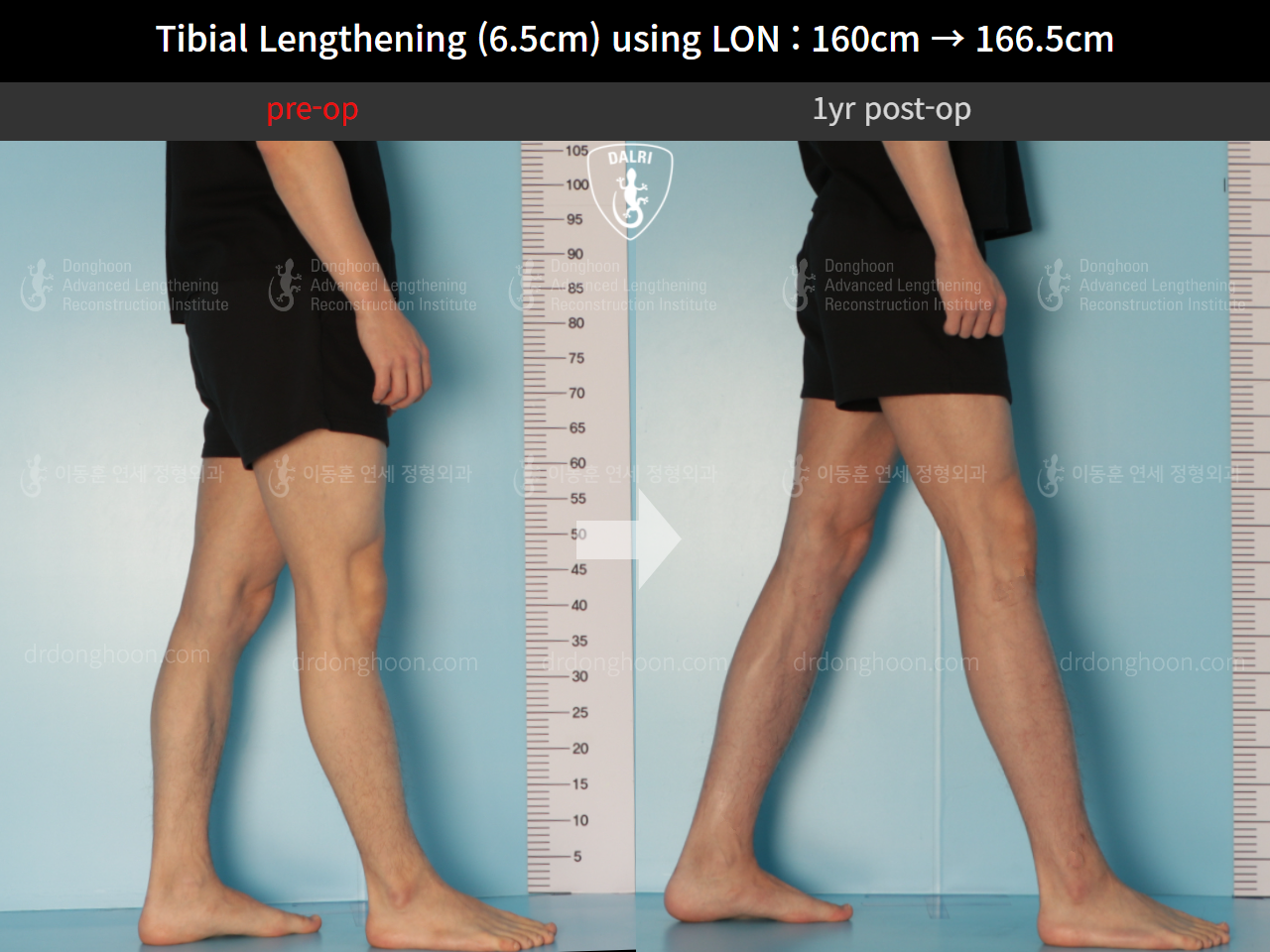 Before and after cll lon, case 10293105, image 8, Dr. Donghoon institute (DALRI)