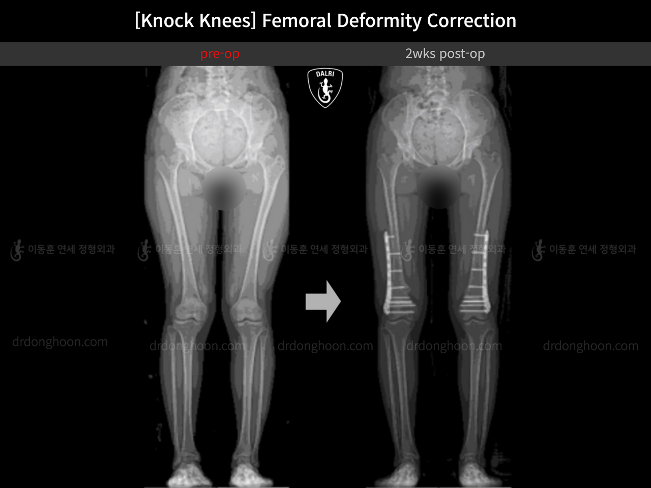 Before and after adult knock knees, case 14343877, image 7, Dr. Donghoon institute (DALRI)