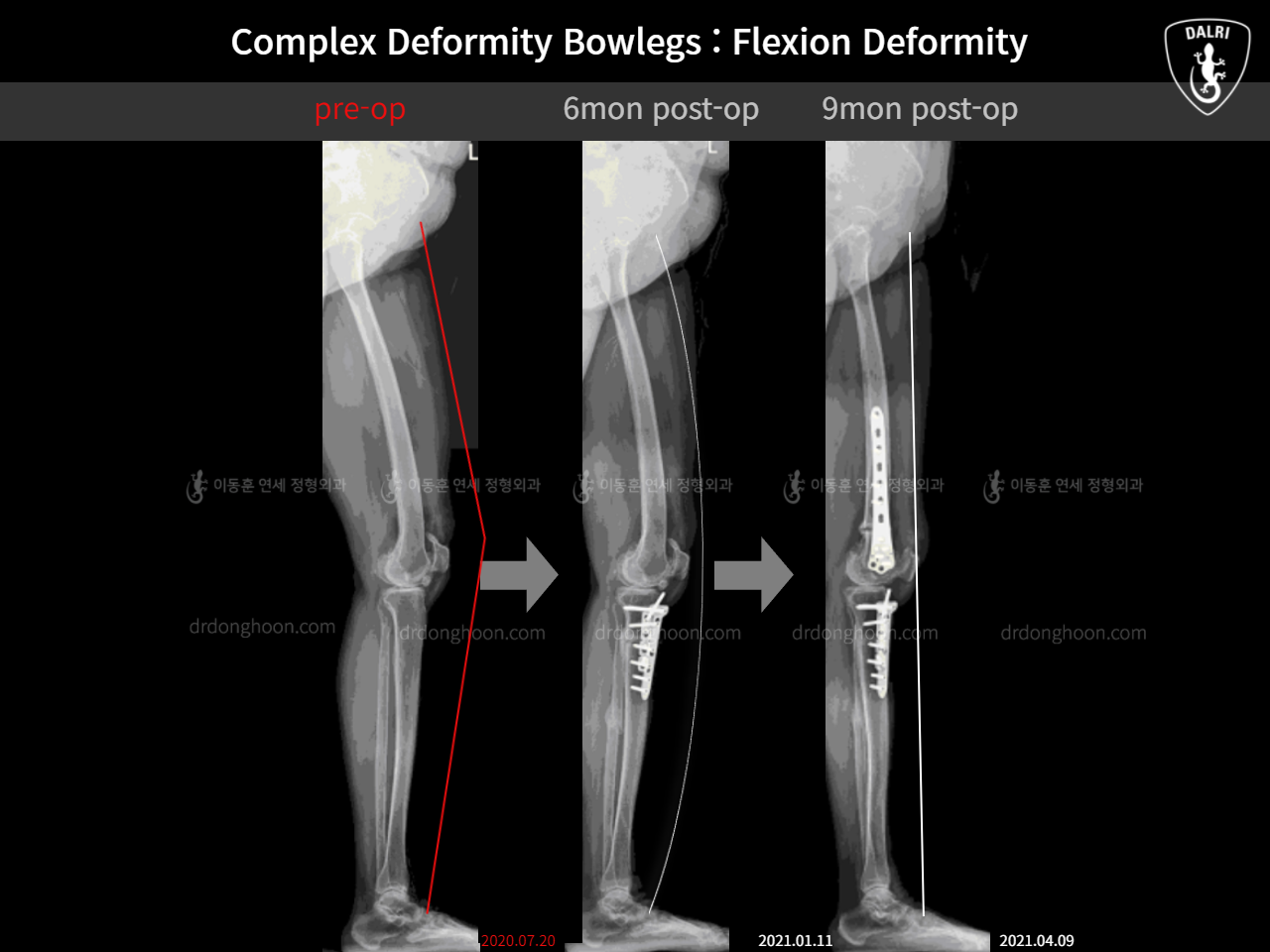 Before and after adult bowlegs, case 11337461, image 10, Dr. Donghoon institute (DALRI)