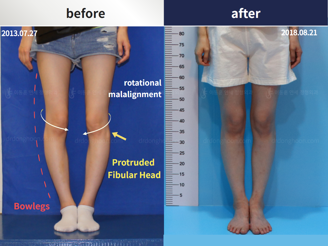 Before and after complex deformity, case 4297345, image 1, Dr. Donghoon institute (DALRI)