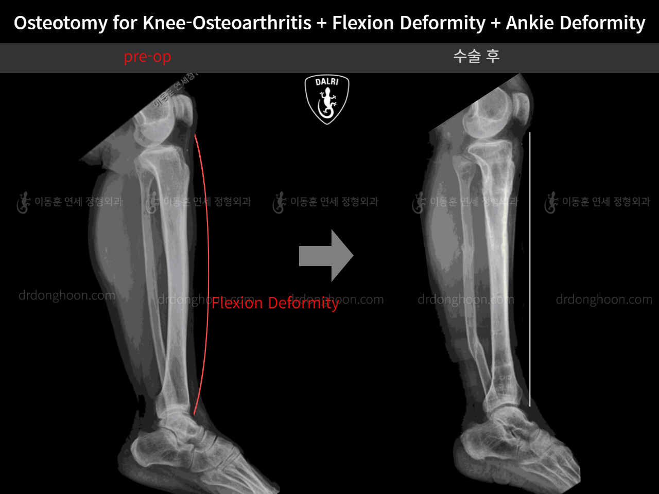 Before and after osteotomy for knee osteoarthritis, case 5315780, image 4, Dr. Donghoon institute (DALRI)