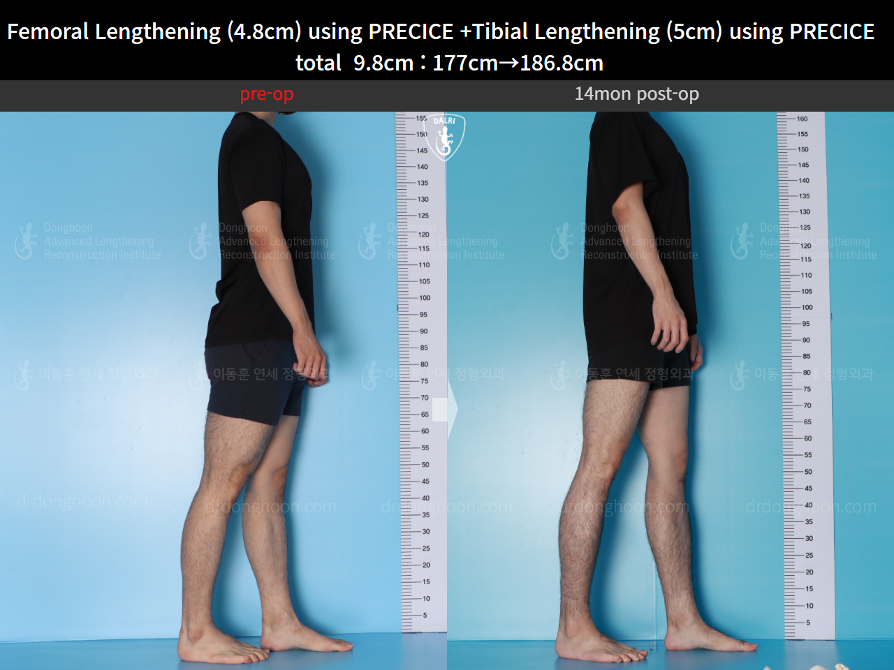 Before and after cll precice, case 16780196, image 4, Dr. Donghoon institute (DALRI)
