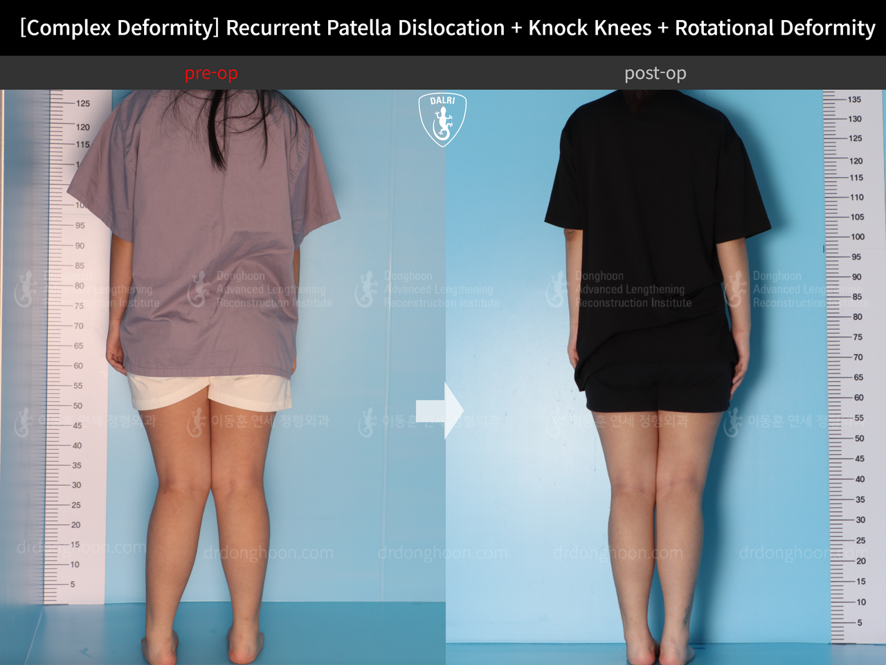 Before and after complex deformity, case 14344403, image 2, Dr. Donghoon institute (DALRI)