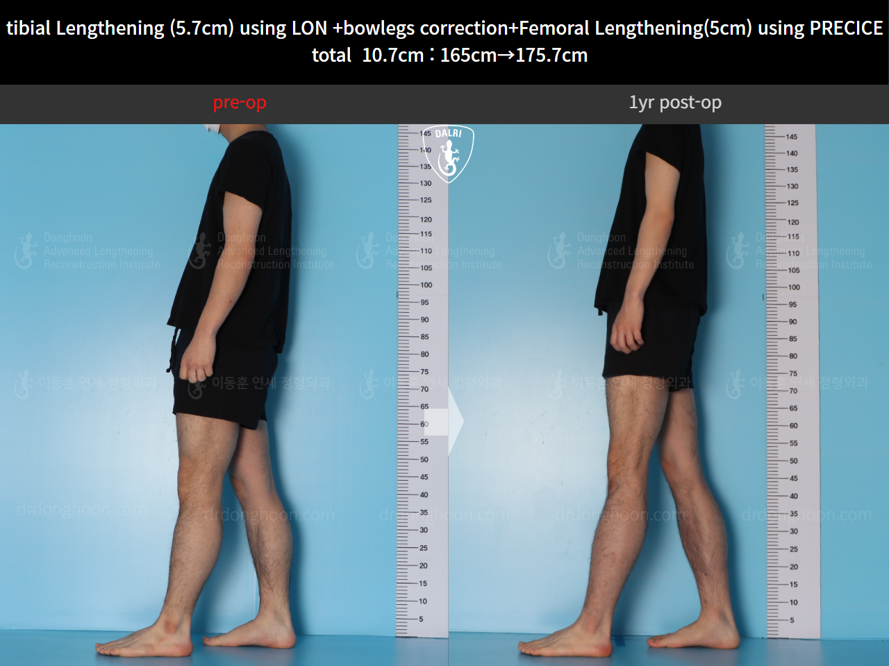 Before and after cll precice, case 20363375, image 3, Dr. Donghoon institute (DALRI)