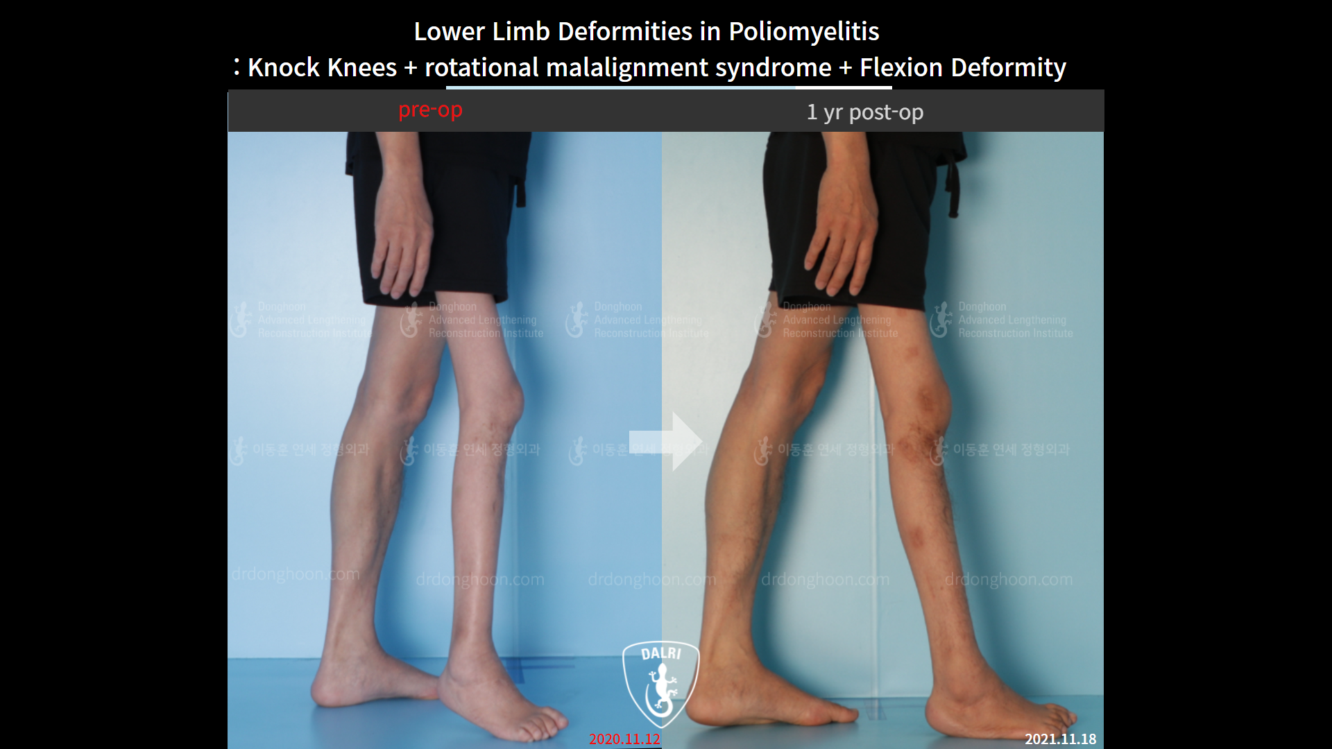 Before and after complex deformity, case 9154937, image 2, Dr. Donghoon institute (DALRI)