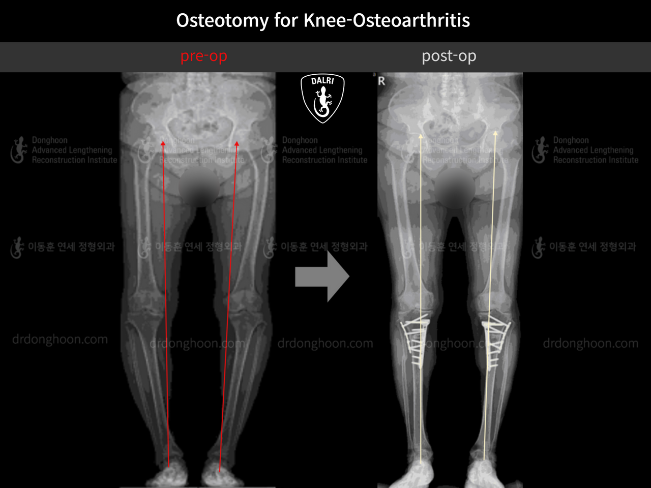Before and after osteotomy for knee osteoarthritis, case 12859739, image 3, Dr. Donghoon institute (DALRI)