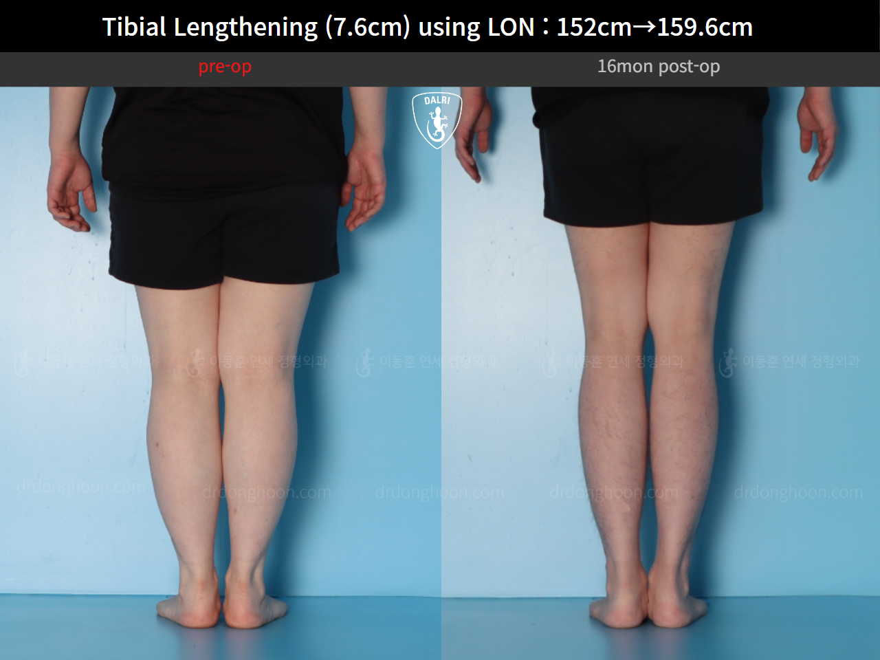 Before and after cll lon, case 123804178, image 6, Dr. Donghoon institute (DALRI)