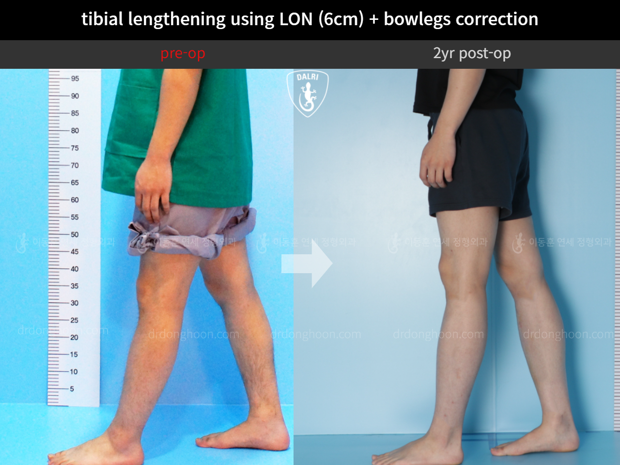 Before and after cll + deformity correction, case 4323141, image 8, Dr. Donghoon institute (DALRI)