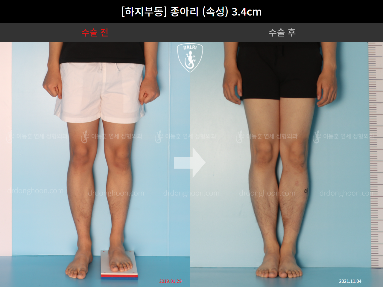 Before and after adult lld, case 4585742, image 4, Dr. Donghoon institute (DALRI)