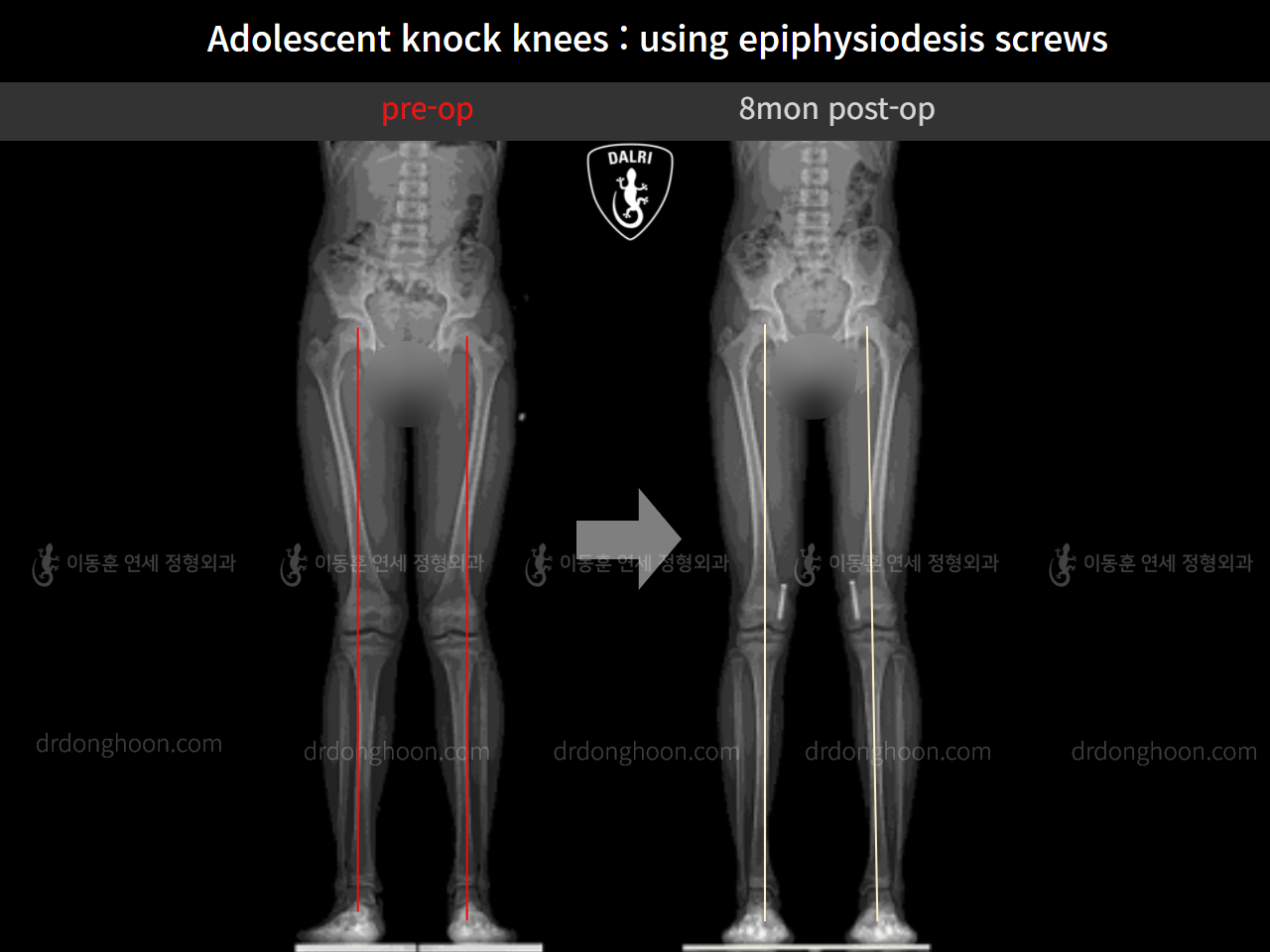 Before and after paediatric & adolescent knock knees, case 10171145, image 10, Dr. Donghoon institute (DALRI)