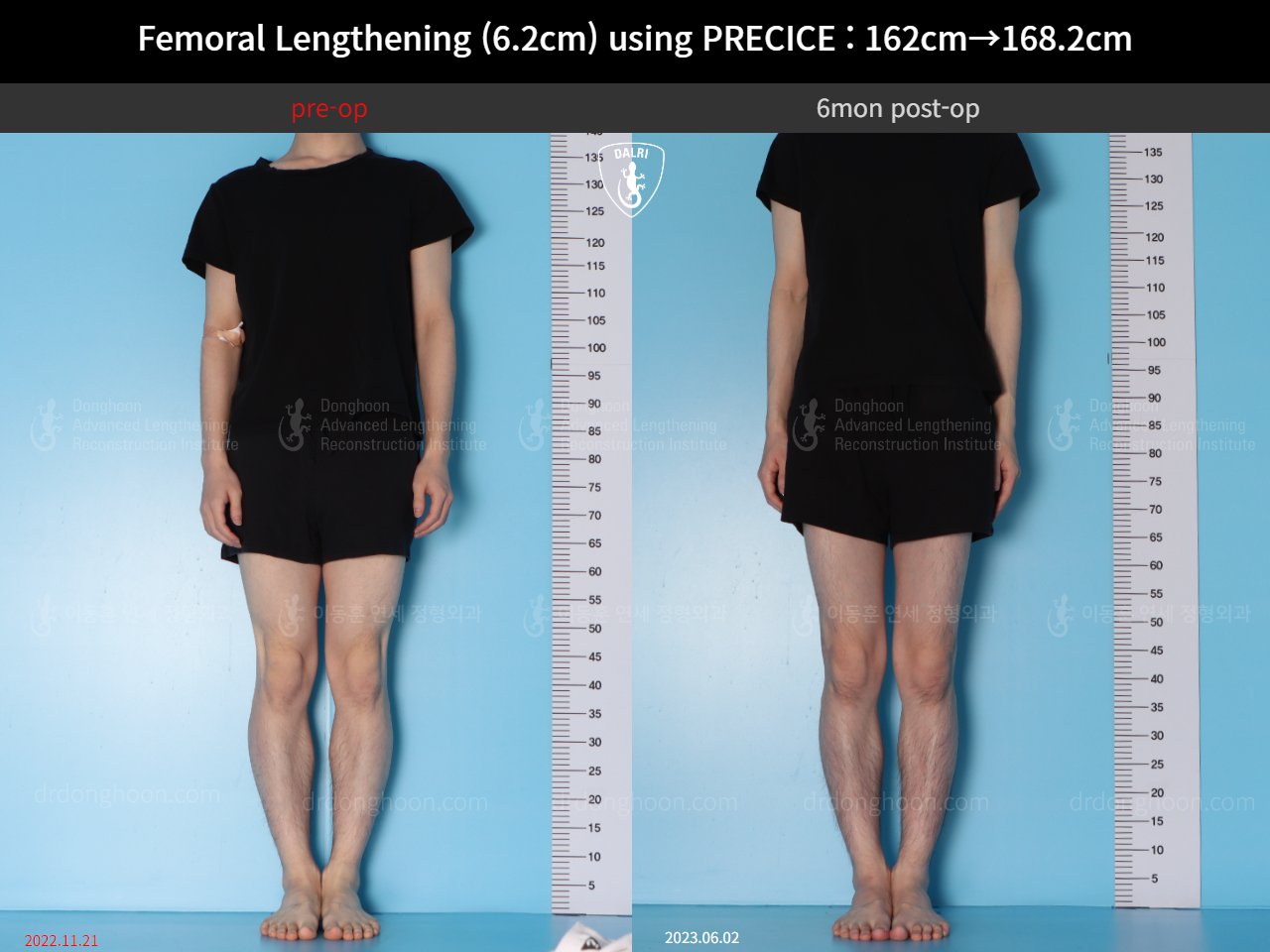 Before and after cll precice, case 15393865, image 1, Dr. Donghoon institute (DALRI)