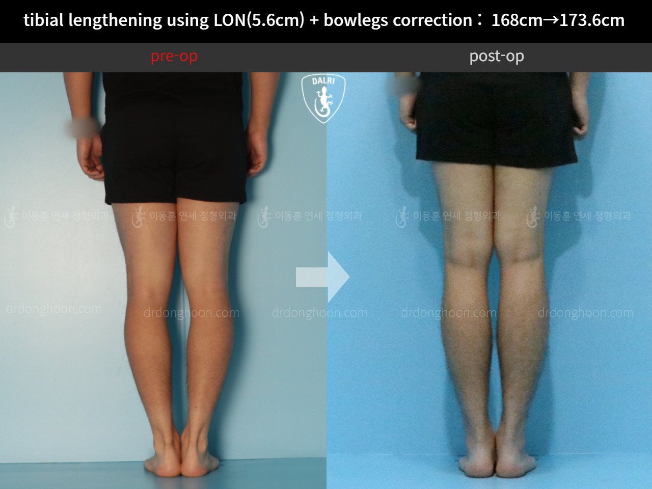Before and after cll + deformity correction, case 11802994, image 6, Dr. Donghoon institute (DALRI)