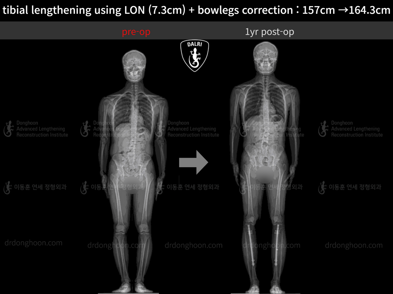 Before and after cll + deformity correction, case 13152543, image 9, Dr. Donghoon institute (DALRI)