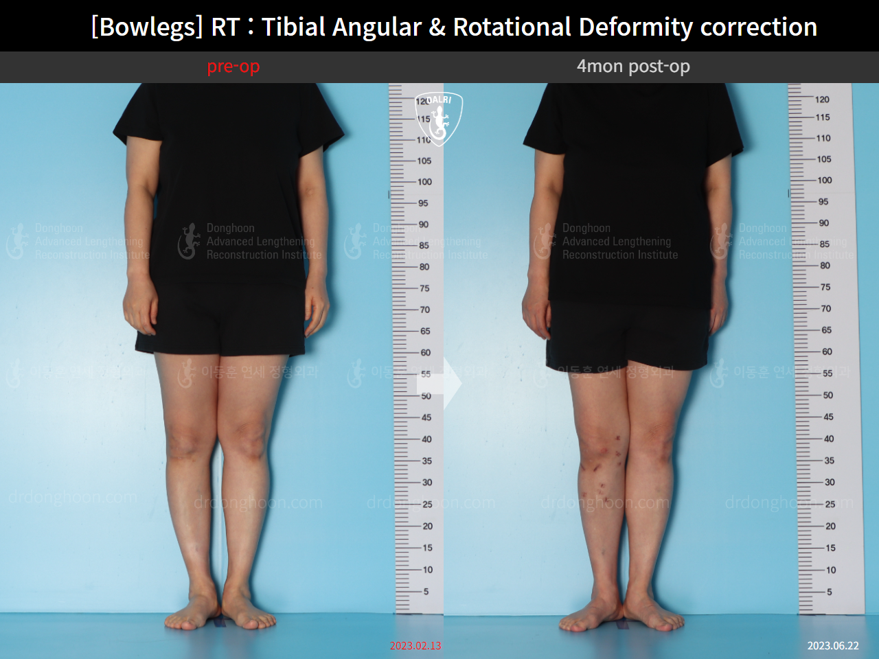 Before and after adult bowlegs, case 15741874, image 2, Dr. Donghoon institute (DALRI)