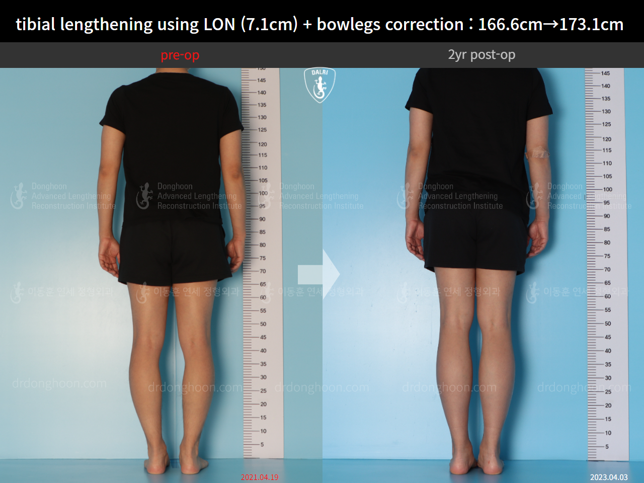 Tibial Lengthening Using LON (7.1cm) + Bowlegs Correction : 166.6cm→173 ...