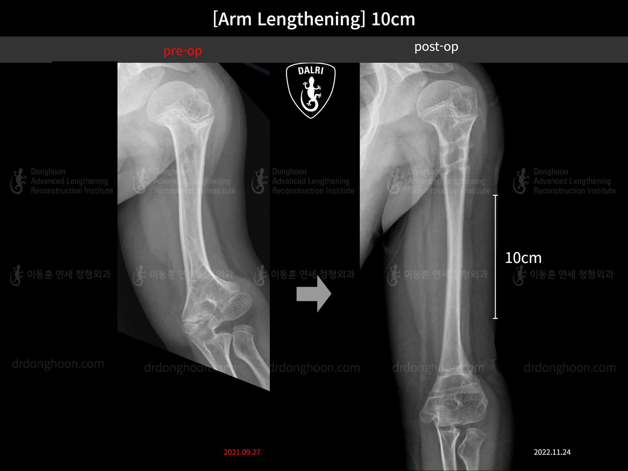 Before and after arm lengthening, case 13536914, image 5, Dr. Donghoon institute (DALRI)