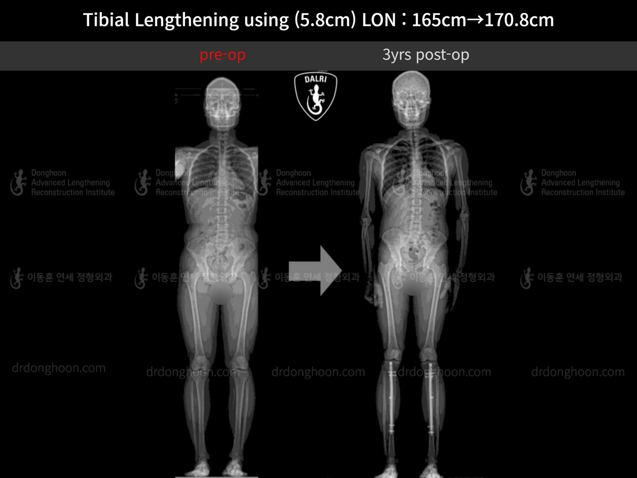 Before and after cll lon, case 12828098, image 8, Dr. Donghoon institute (DALRI)